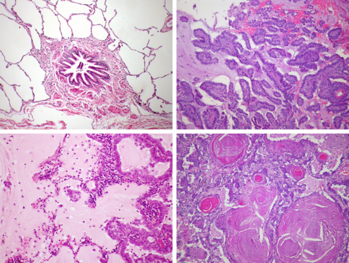 Revolutionary Test Predicts Lung Cancer Outcomes Using Tumor DNA