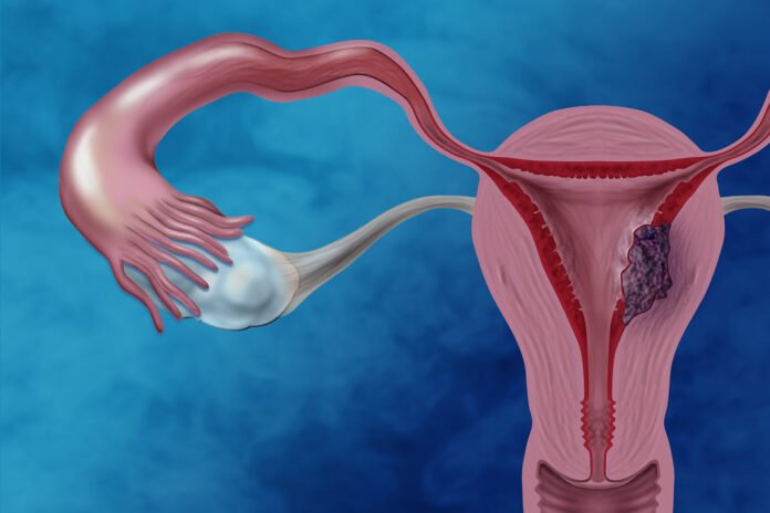 Gynecological Cancer