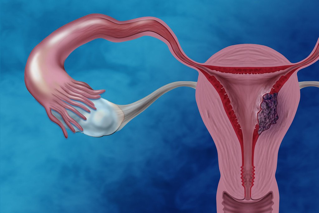 Gynecological Cancer Gynecological Cancer