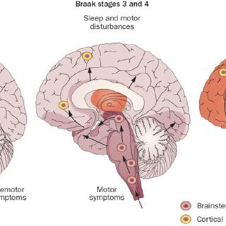 Neurodegenerative Diseases