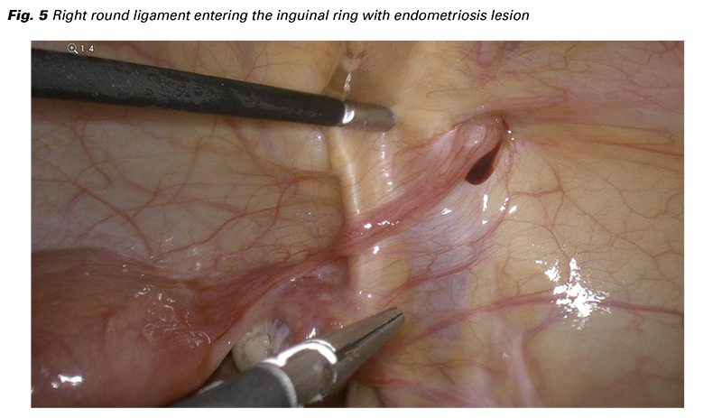 Endometriosis Endometriosis