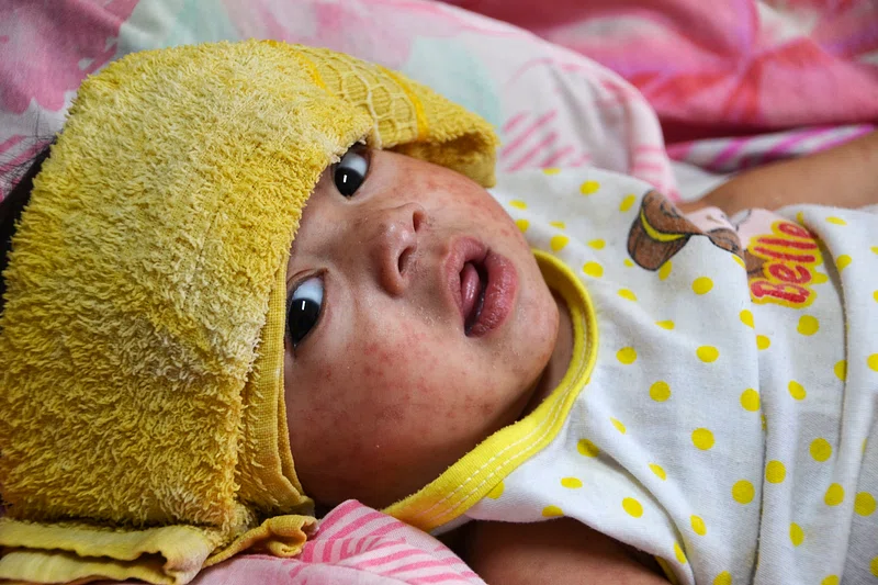 Early Measles Vaccination Early Measles Vaccination