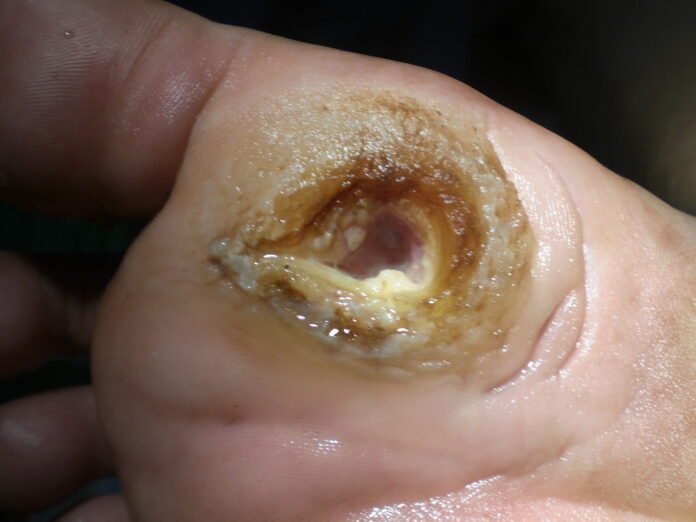 Diabetic Foot Ulcers