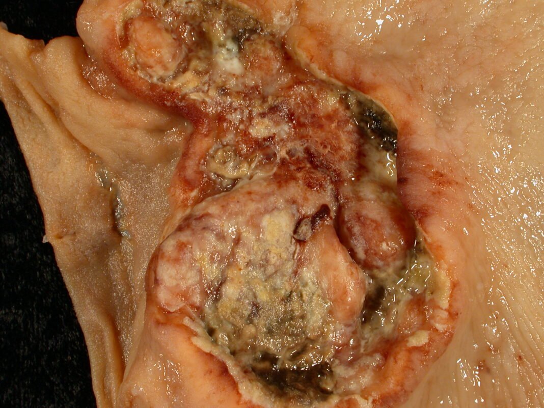 Gastric Cancer Gastric Cancer