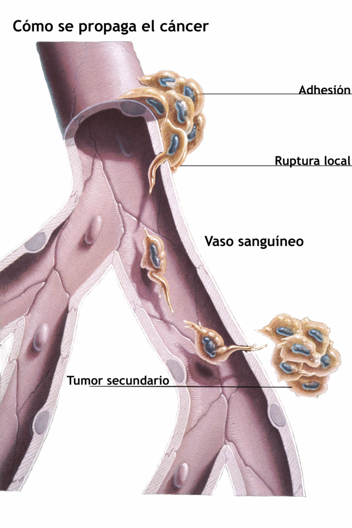 Cancer Metastasis