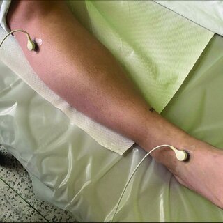 Chronic Limb-Threatening Ischemia